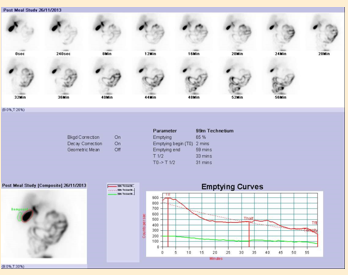 <p><span><span>•Prompt spread of isotope through liver and ducts</span></span></p><p><span><span>•GB filling at 20 minutes</span></span></p><p><span><span>•Between 35-75% empty at end of examination</span></span></p><p></p>