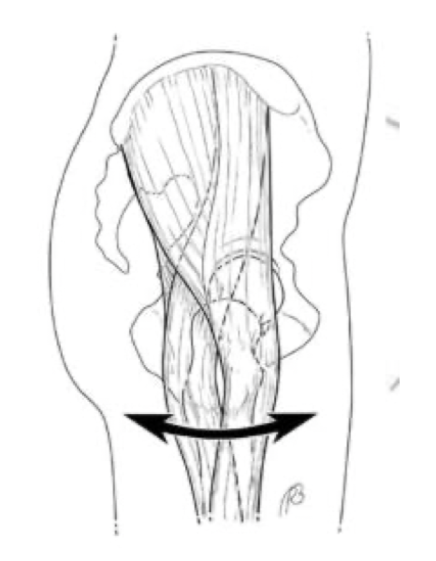 <p>What type of Coxa Saltans is caused by IT band or gluteus maximus tendon snapping over the greater trochanter (runners, dancers)</p>