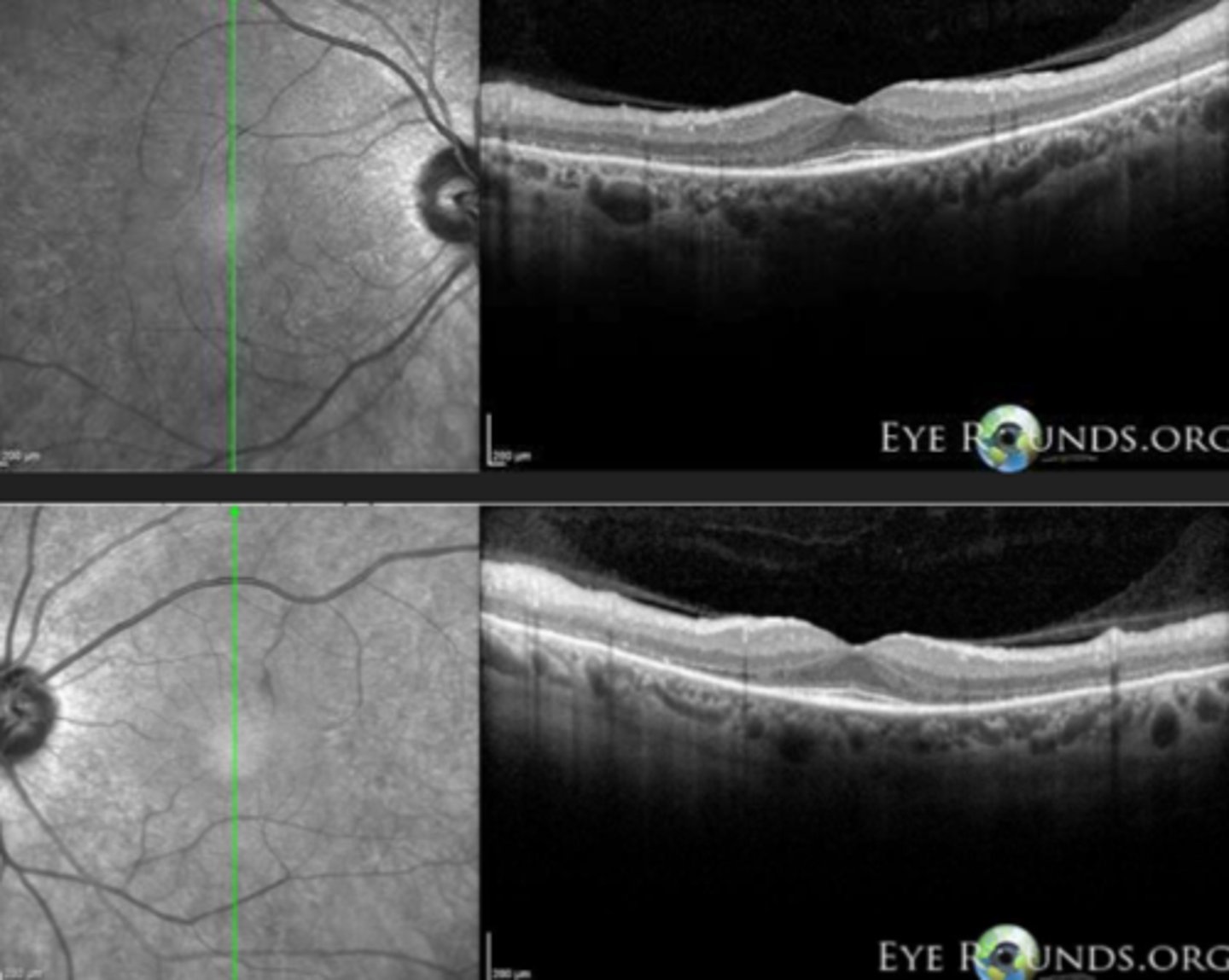 <p>perifoveal loss of PR's and RPE on OCT = ring scotoma very close to fixation seen on HVF</p>