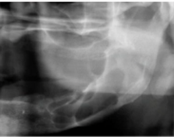 <p>lesion with multiple compartments or septations </p>