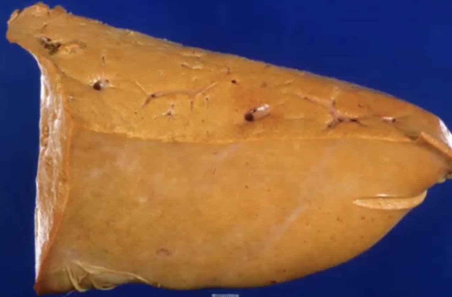 <p>Bovine liver: What has caused this gross appearance ?</p>