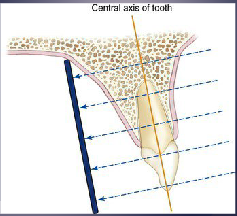 <p>The central ray is directed at right angle to the central axes of Object and Receptor (preferred method to minimize distortion)</p>
