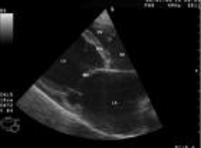 <p><span>The image above is a parasternal long axis view and MOST likely represets which of the following pathologies?</span></p><p></p><p>dilated cardiomyopathy</p><p></p><p>hypertrophic cardiomyopathy</p><p>&nbsp;</p><p>hypertrophic obstructive cardiomyopathy</p><p>&nbsp;</p><p>restrictive cardiomyopathy</p>