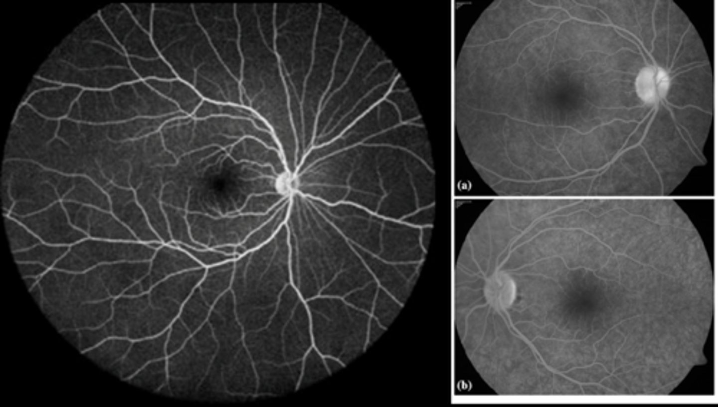 <p>sclera</p><p>optic nerve head</p><p>drusen?</p><p>glial tissue (Bergmeister)</p><p>fibrotic scarring</p>