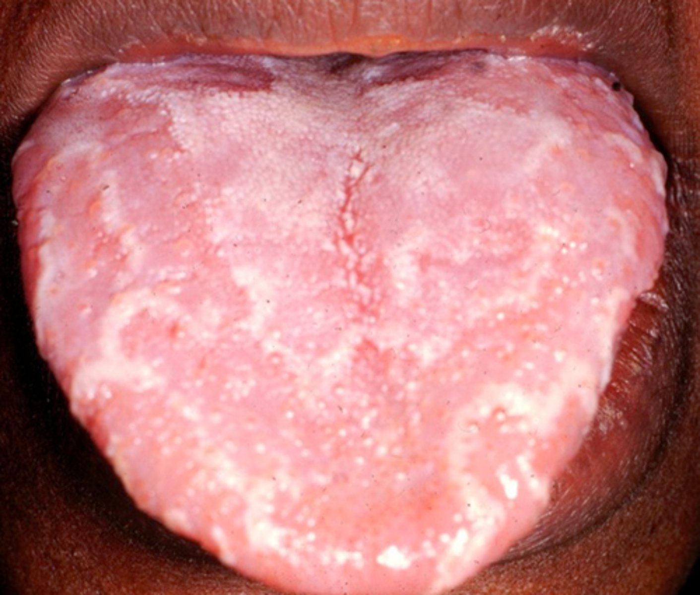 <p>AKA benign migratory glossitis</p>