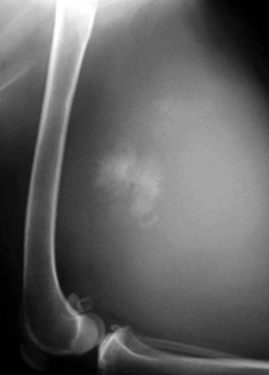 <p>Name a few examples of juxta-articular calcified bodies?</p>