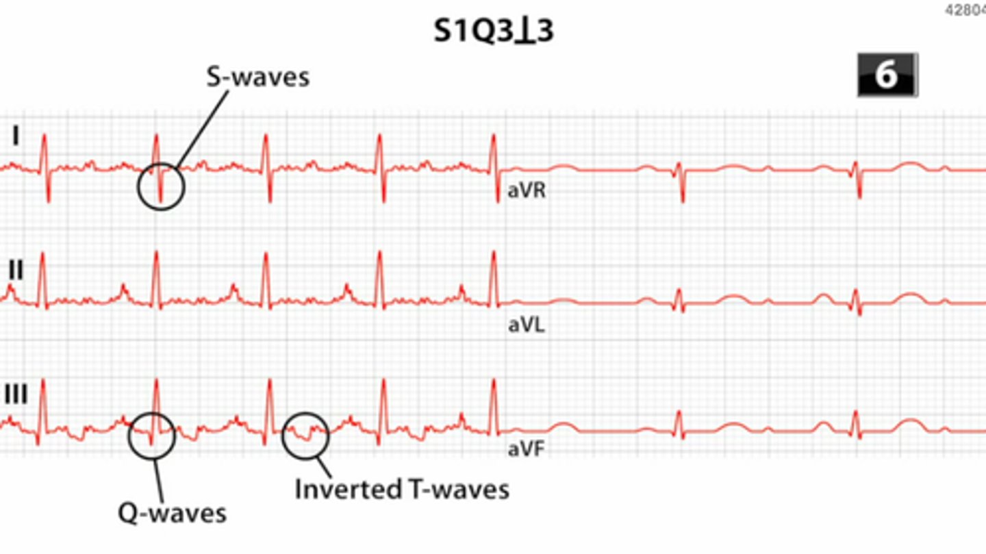 <p>EKG findings in PE</p>