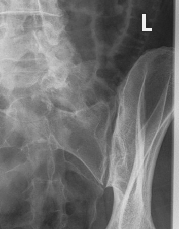 <p>1" medial to the raised ASIS.</p>