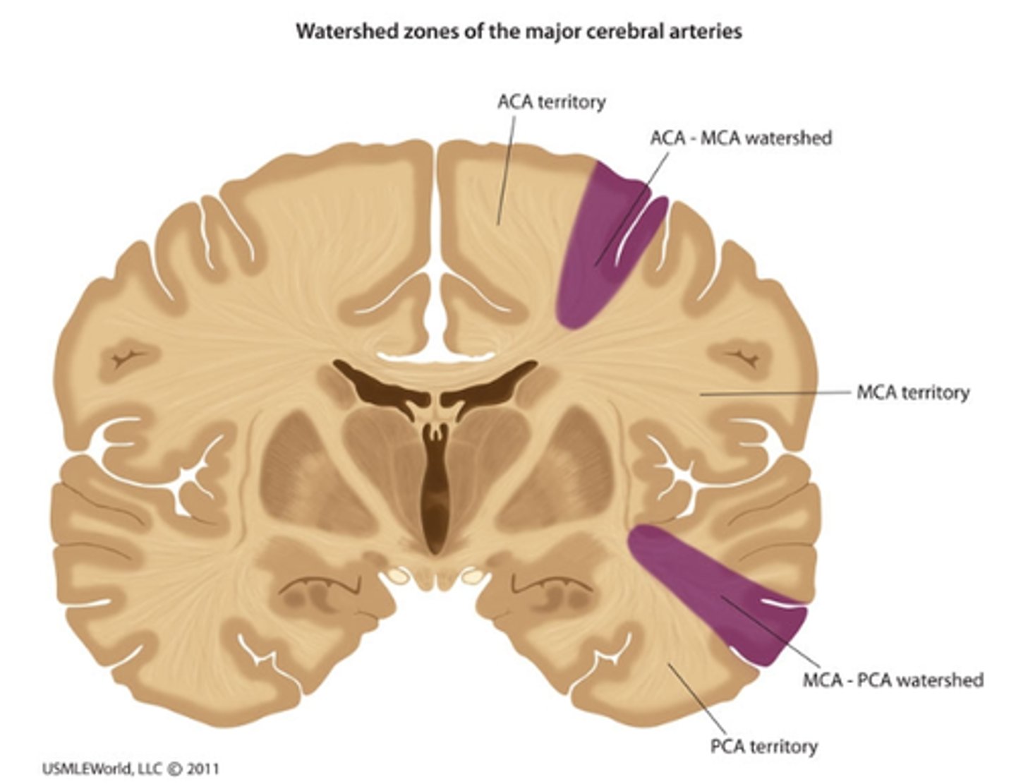 <p>(where distal cerebral arteries anastomose is vulnerable to ischemia)</p><p>· Impairments: upper limb paresis and paresthesias</p>