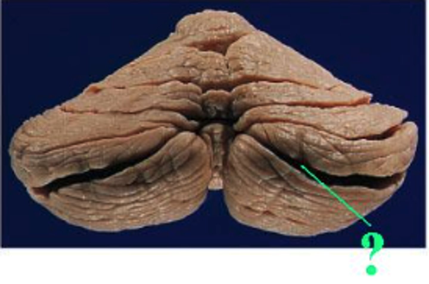 <p>horizontal fissure</p>