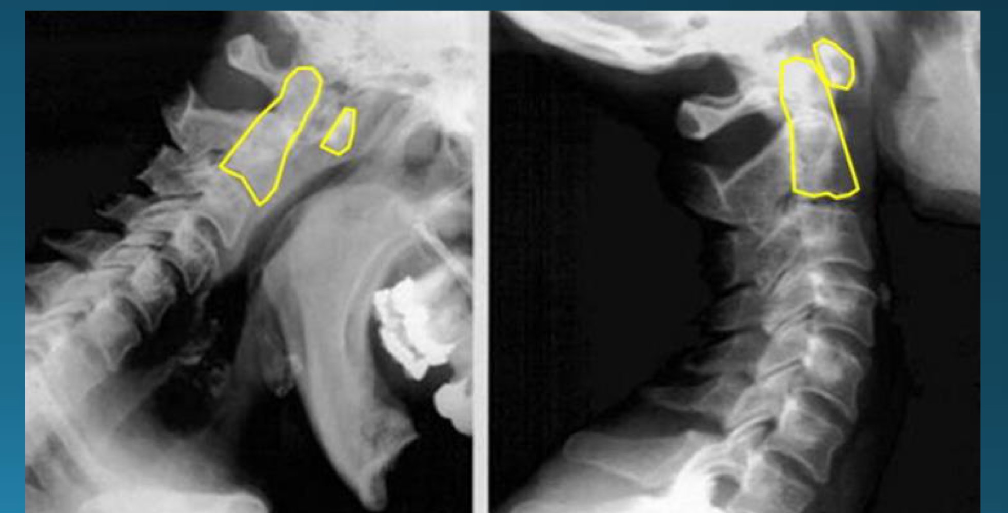 <p>what’s happening in this image?</p><p>may be part of what arthritic diagnosis? </p>