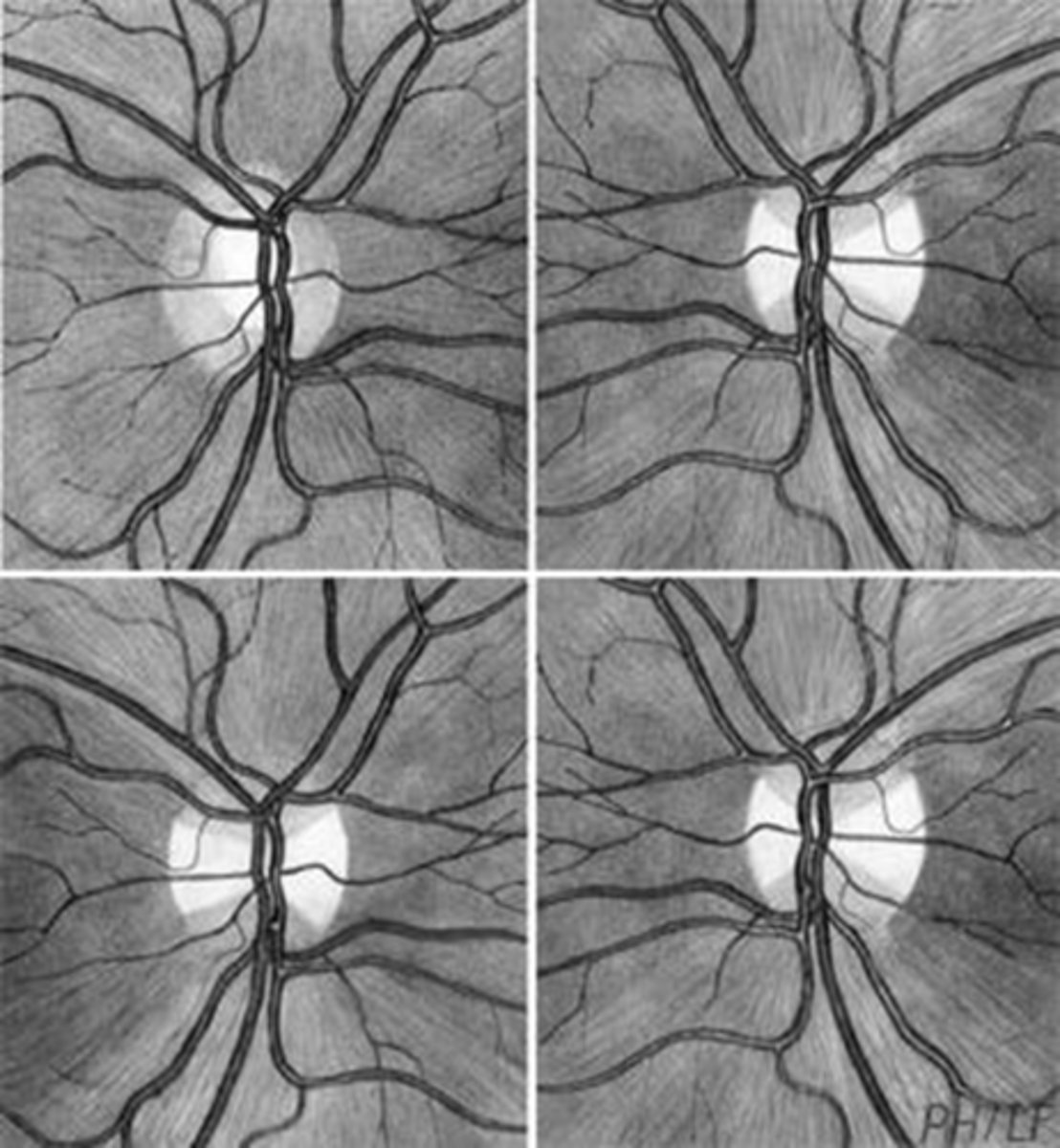 <p>optic tract lesions = carry ipsilateral temporal fibers and contralateral nasal fibers</p><p>optic chiasm lesions = bilateral bow tie</p>