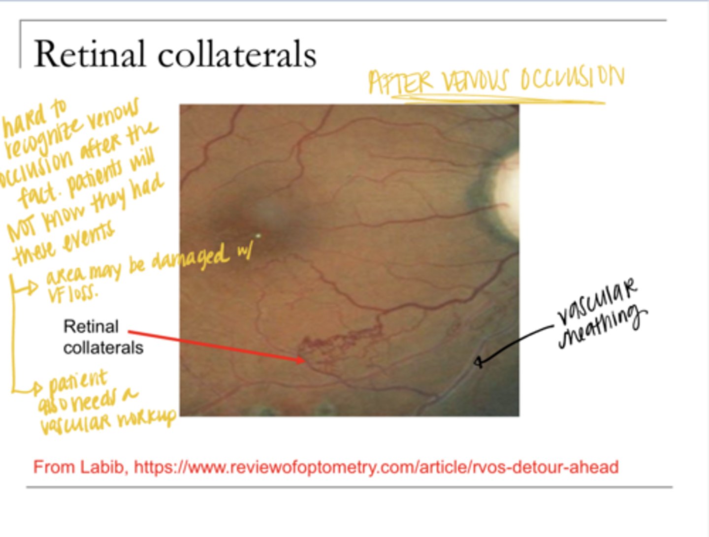 <p>Is it hard to recognize a venous occlusion after the fact once all the blood &amp; edema clear?</p>