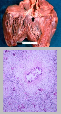 <p>Gross:</p><ul><li><p>palpable calcium granules</p></li><li><p>feel knife grating upon sectioning</p></li><li><p>chalk-white colour usually. Can be yellowish/green due to eosinophils if parasites are involved</p></li></ul><p>Histo:</p><ul><li><p>dark blue colour</p></li><li><p>microtome mark due to shattering of tissue</p></li><li><p>Von Kossa stain turns it black</p></li></ul><p></p>