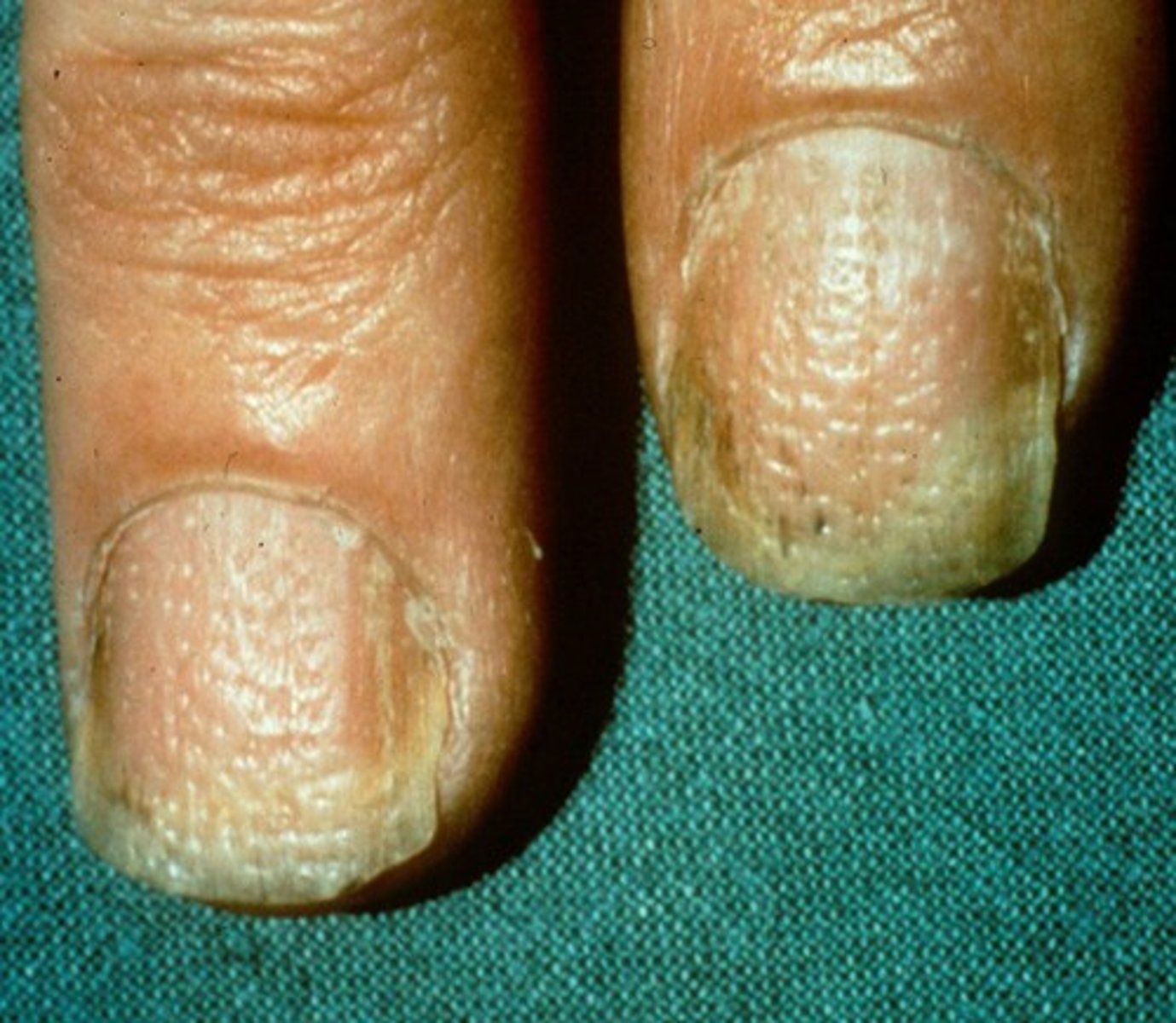 <p>diagnose this image:</p><p>classically presents with pitting and an "oil drop sign"</p>