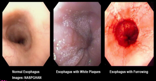 <p><strong>Eosinophilic Esophagitis: Background</strong></p><p>-______, immune/antigen-mediated disease </p><p>-Pathogenesis → interplay between _______, environmental, and host immune system factors </p><p>-Associated Disorders → food allergies, environmental allergies, _______, and atopic dermatitis </p><p>-Symptoms → ___________ (especially solids), food impaction, chest pain, ____, upper abdominal pain</p>