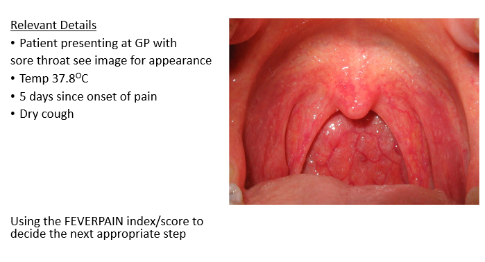 <p>The symptoms, particularly the duration of pain, temperature elevation, and dry cough, may suggest a viral respiratory infection, such as the common cold or influenza.</p><p>Most likely viral - strep throat due to erythema (redness), uvula not deviated, no enlarged tonsils </p>