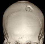 Depressed fracture
