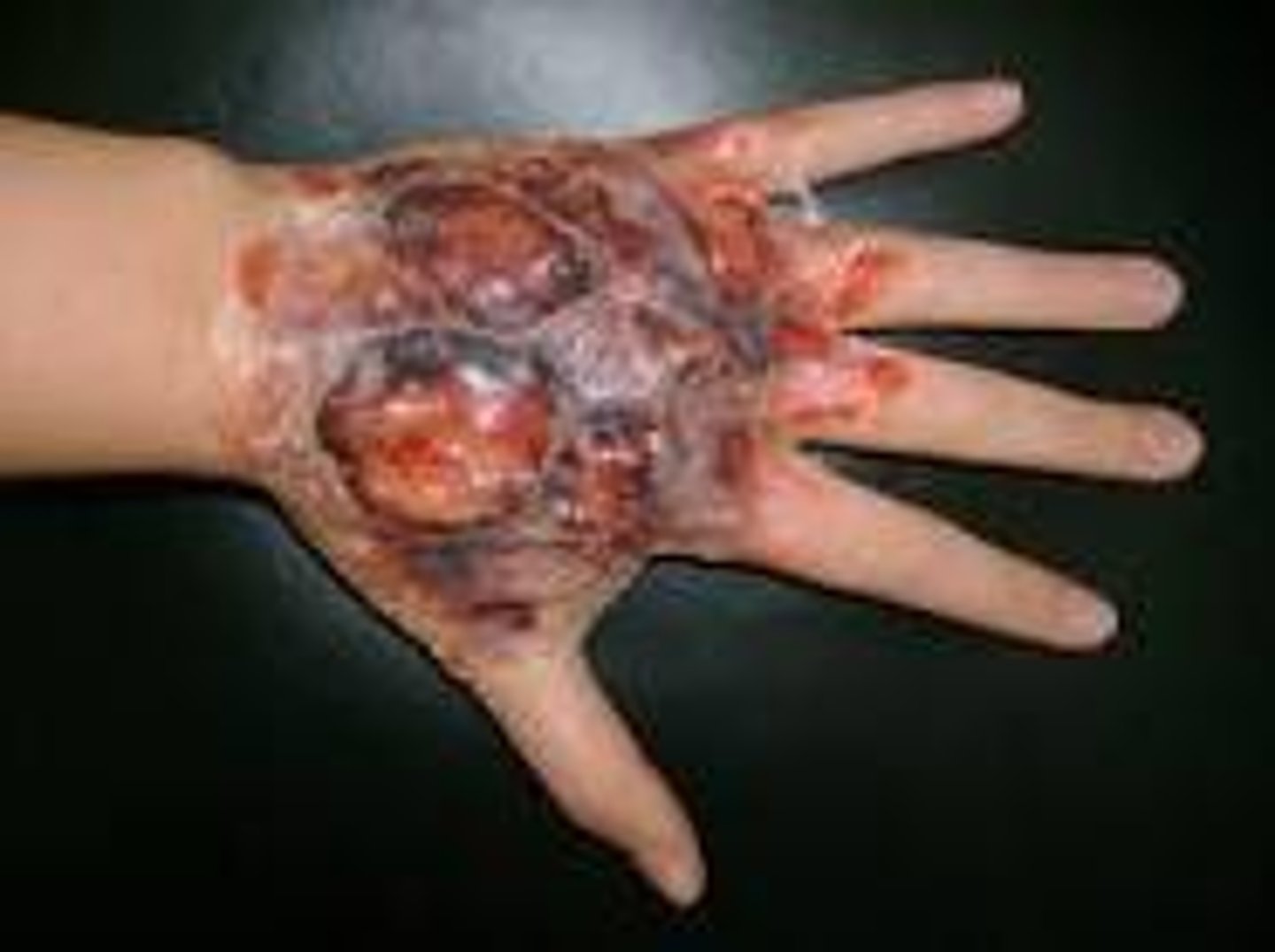 <p>epidermis/dermis/subcutaneous tissue; charred, dry and exposed deep tissue; requires surgical interventions and amputation/paralysis is possible.</p>