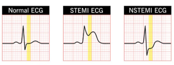 <p>NSTEMI (Non-Elevated ST)<br>STEMI (Elevated ST)</p>
