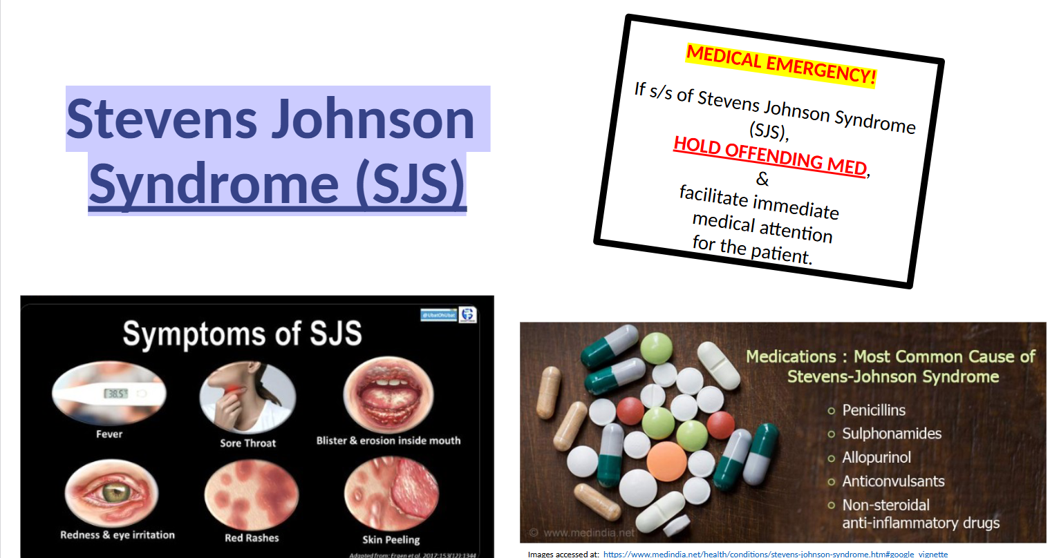 <p>a rare, life-threatening skin disorder often triggered by medications that causes painful, blistering rashes, fever, and skin peeling. It affects mucous membranes (eyes, mouth, genitals) and requires immediate hospitalization, </p>