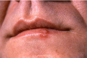 <p>vesicular growths on the lip due to the reactivation of herpes simplex 1 (HSV 1)</p>