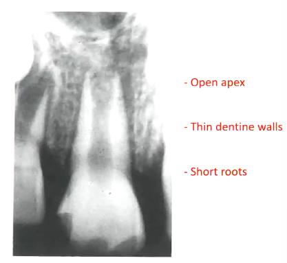 <p>A method of inducing a <strong><u>calcified barrier</u></strong> at the apex of a <strong><u>non-vital</u></strong><u> </u>tooth with incomplete root formation by the use of <strong><u>CaOH as a canal medicament </u></strong></p><p></p><p>you change the CaOH every few months </p>