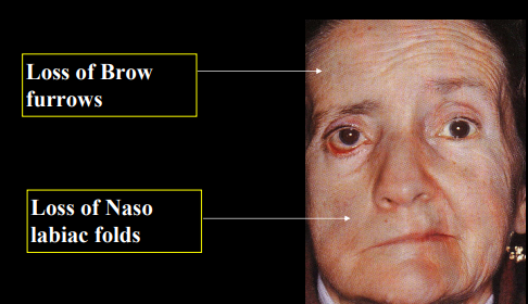 <p>C - you would see ectropion instead, which is why you should also check for corneal dessication</p>