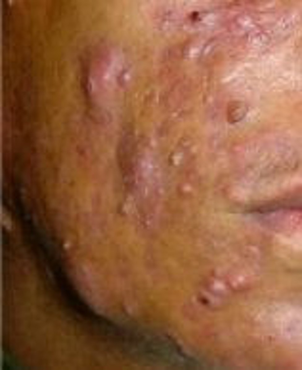 <p>Uncommon, severe form of acne with painful pustules</p>