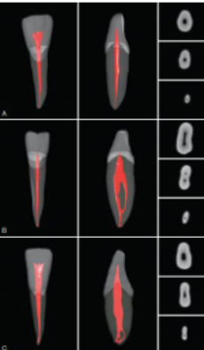 <p>lateral bifurcates more often than central</p>