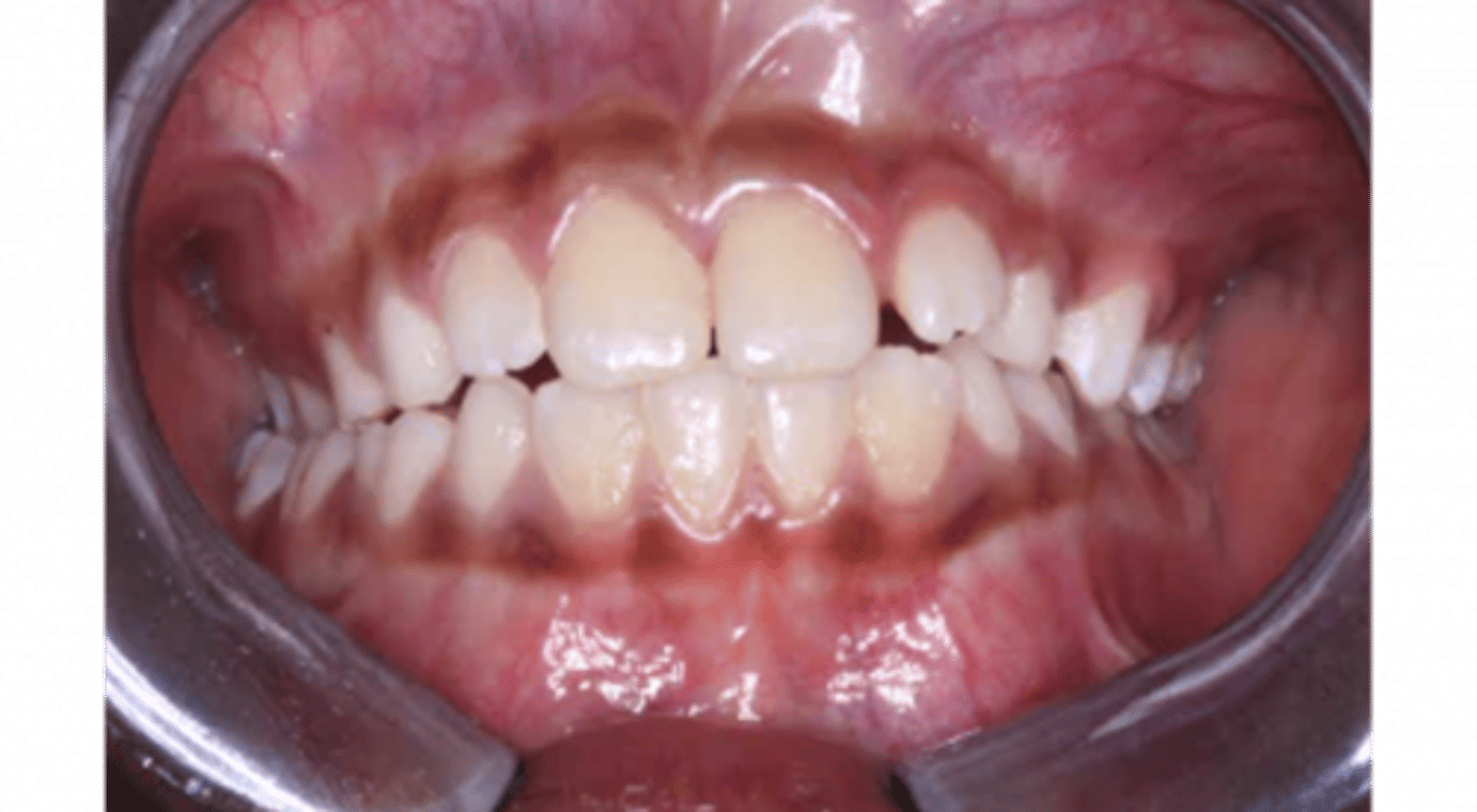 <p>Normal physiologic pigmentation of oral mucosa</p><p><br><span>what is the coloration of the mandibular gingiva that is considered a variant of normal called</span></p>