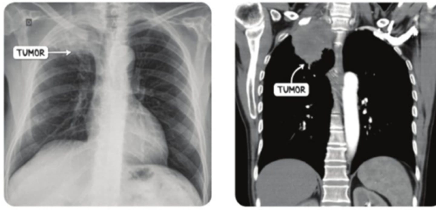 <p>-CT of chest: tumor in lung apex </p><p>-biopsy= confirm </p>