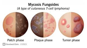 <p>PP/E: cutaneous T-cell lymphoma<br>skin→dormant for years (or)→progresses to systemic disease</p><p>CM: scaly patches/plaques on trunk<br>itchy<br>localized/systemic<br>erythematous</p><p>DX: multiple punch biopsies</p><p>TX: topical chemotherapy<br>UV light phototherapy<br>systemic chemotherapy<br>immunotherapy<br>topical steroids</p><p><em>commonly mistaken for eczema/tinea/psoriasis</em></p>