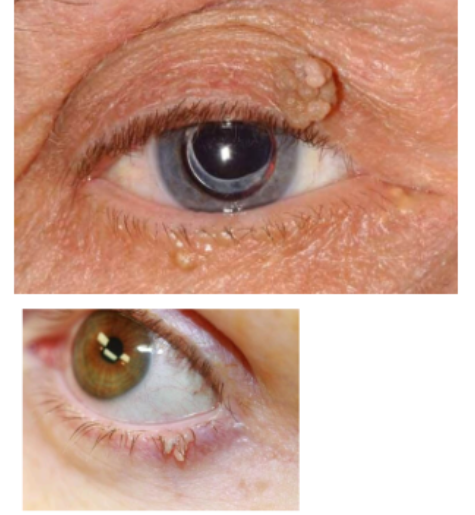 <p>squamous papilloma</p>