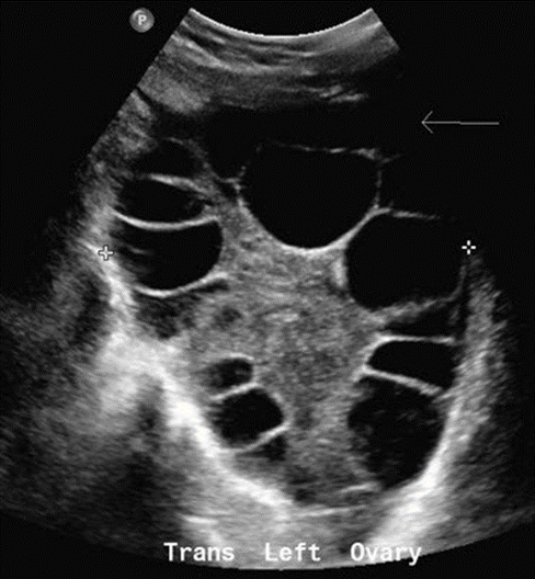 <p>Theca Lutein Cysts</p>
