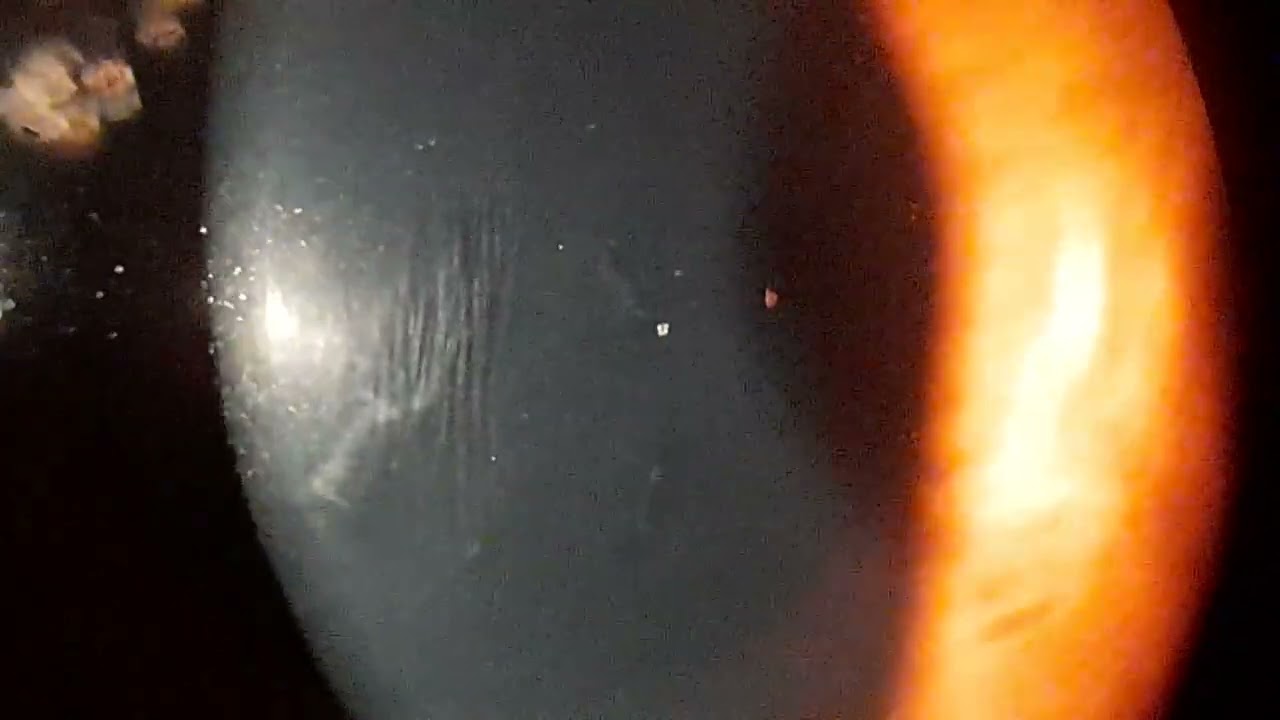 <ul><li><p><span>Fine vertical lines / stretch marks seen in the posterior stroma of Descemet’s membrane&nbsp;</span></p></li></ul><p></p>