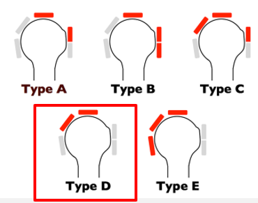 <p>which tendon is most commonly torn in rotator cuff?</p>