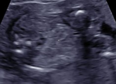<p>The sonographer is scanning at the level of the kidneys and does not note them. What can be assumed here?</p>