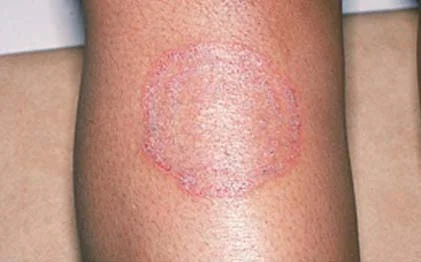 <p>ringworm</p><p></p><p>erythema, pruritic, annular lesion w/ raised border and central clearing</p>
