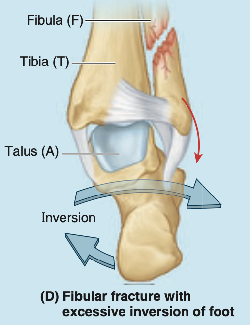 <p>often are associated with fracture-dislocations of the ankle joint</p><p></p><p>when a person slips, forcing the foot into an excessively inverted position, the ankle ligaments tear, forcibly tilting the talus against the lateral malleolus and shearing it off</p>