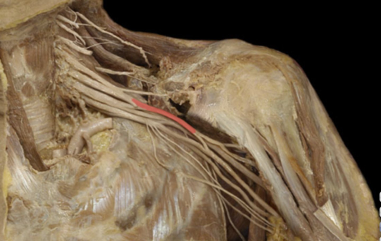 <p>formed by the anterior divisions of upper and middle trunks; C5-C7</p>