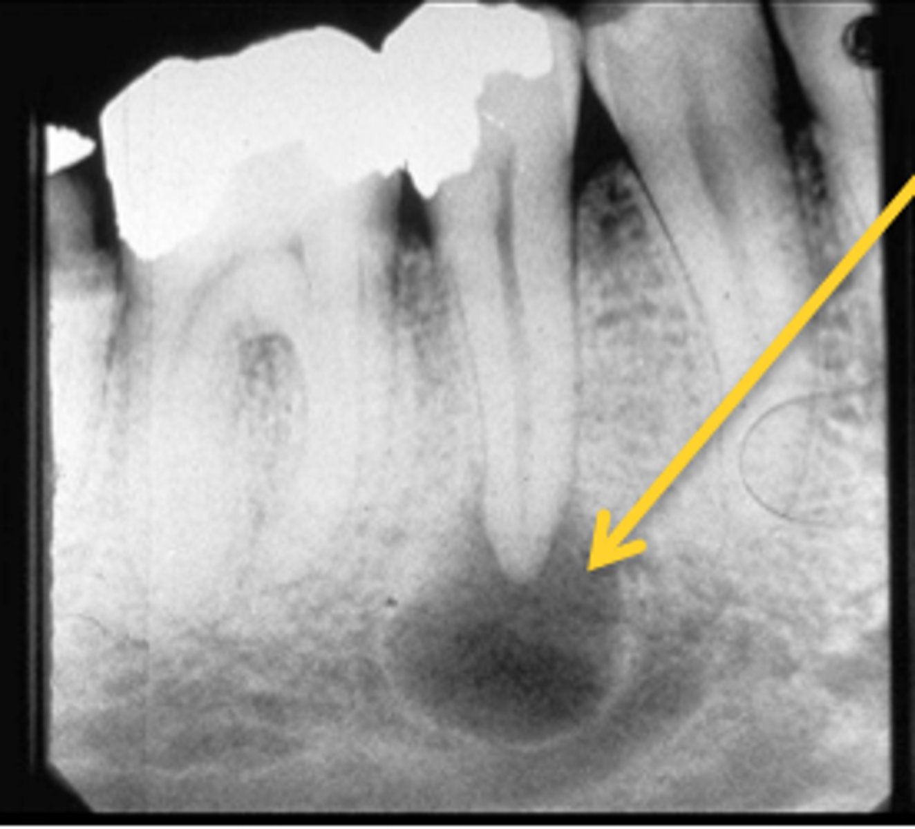 <p>radicular cyst not removed with extracted tooth</p>
