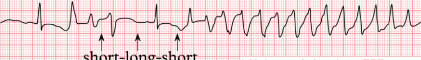 <p>Determine the ventricular dysrhythmia:</p><ul><li><p><span>potentially fatal type of polymorphic ventricular tachycardia (a rapid, irregular heart rhythm)</span></p></li><li><p>QT internal is lengthening</p><ul><li><p><span>QRS complexes appear to <strong>twist </strong>around the ECG baseline, a sign of a prolonged QT interval</span></p></li></ul></li></ul><p></p>