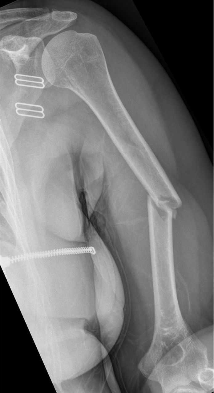 <p><span>A 22 year old woman presents to her local hospital following an electric scooter accident. She presents with significant pain and weakness, limiting movement at the shoulder and elbow.</span></p>