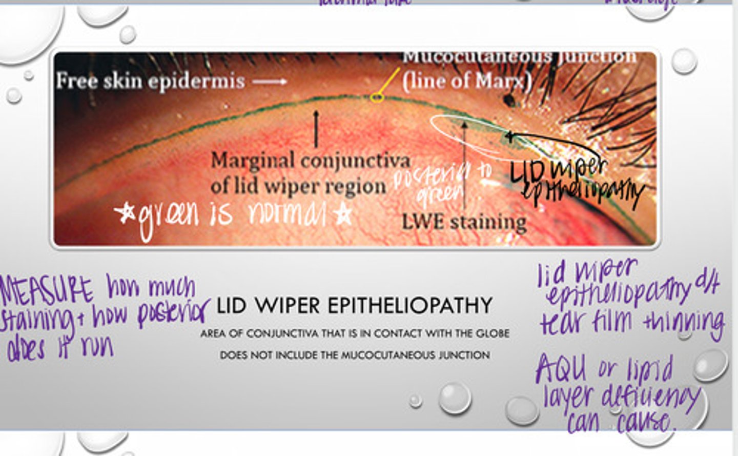 <p>Does aqueous deficient or lipid layer deficient dry eye cause lid wiper epitheliopathy?</p>