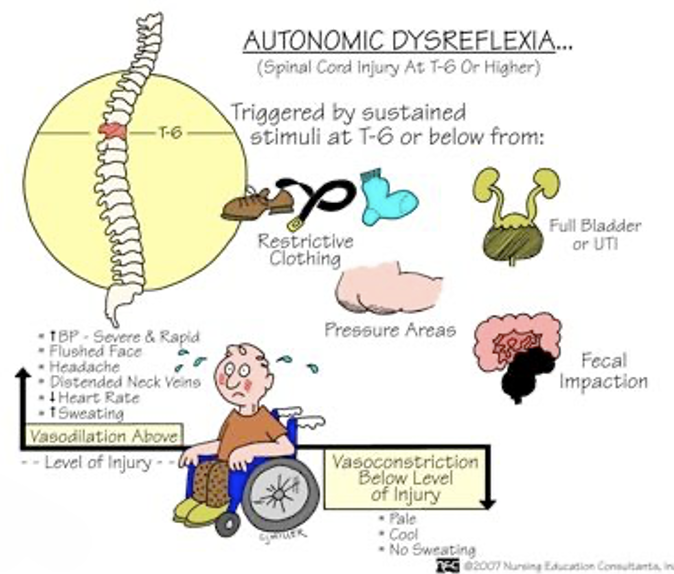 <p>Life-threatening emergency in patients with SCI where exaggerated autonomic responses to stimuli that causes <span style="color: red"><strong>hypertensive emergency! </strong></span>(injuries @ T6 or above)</p><ul><li><p><strong>Clinical Manifestations</strong>:</p><ul><li><p>Severe, pounding headache with paroxysmal hypertension</p></li><li><p>Profuse sweating above spinal level of injury</p></li><li><p>Nausea</p></li><li><p>Nasal congestion</p></li><li><p>Bradycardia</p></li></ul></li><li><p><strong>Stimuli could be</strong>: @ T6 or below</p><ul><li><p><span>Distended bladder (most common)</span></p></li><li><p><span>Constipation, fecal impaction (distention of contraction of visceral organs)</span></p></li><li><p><span>Tactile pain, thermal pain, pressure injury (stimulation of the skin), ingrown toenail</span></p></li><li><p><span>Sexual stimulation, childbirth</span></p></li></ul></li><li><p>Remove the stimuli &amp; place patient immediately in sitting position to lower blood pressure</p><ul><li><p>Loosen tight clothing</p></li></ul></li></ul><p></p>