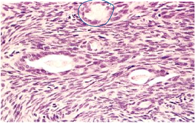 <p>rare soft tissue tumor that occurs <strong><span style="color: red">near joints but not usually in joints</span></strong></p><ul><li><p><strong><mark data-color="blue">associated with gene fusions </mark><span style="color: purple"><mark data-color="blue">SS18-SSX1, -SSX2, or -SSX4</mark></span><mark data-color="blue"> (chimeric transcription factors)</mark></strong></p></li><li><p><strong><mark data-color="blue">probably arises from multipotential mesenchyme</mark></strong></p></li></ul><p>clinical presentations</p><ul><li><p>can present in <strong><mark data-color="blue">locations that lack synovium (chest wall, head, neck)</mark></strong></p></li><li><p><strong><mark data-color="green">most occur in people in their 20s - 40s</mark></strong></p></li><li><p>microscopically has a<strong><mark data-color="blue"> biphasic pattern of spindle cells &amp; glands</mark></strong></p></li></ul>