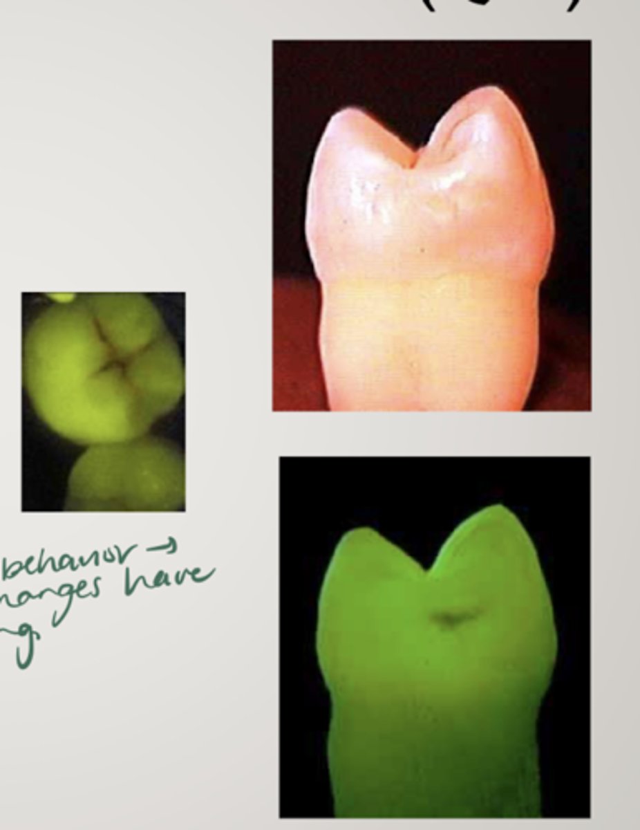 <p>laser is used to measure induced tooth fluorescence</p><p>measures changes in fluorescence that result from carious lesions scattering light</p><p>contrast between sound and pathogenic tissue</p><p>potential for longitudinal evaluation of lesions, ability to measure remineralization protocols</p><p>expensive</p>