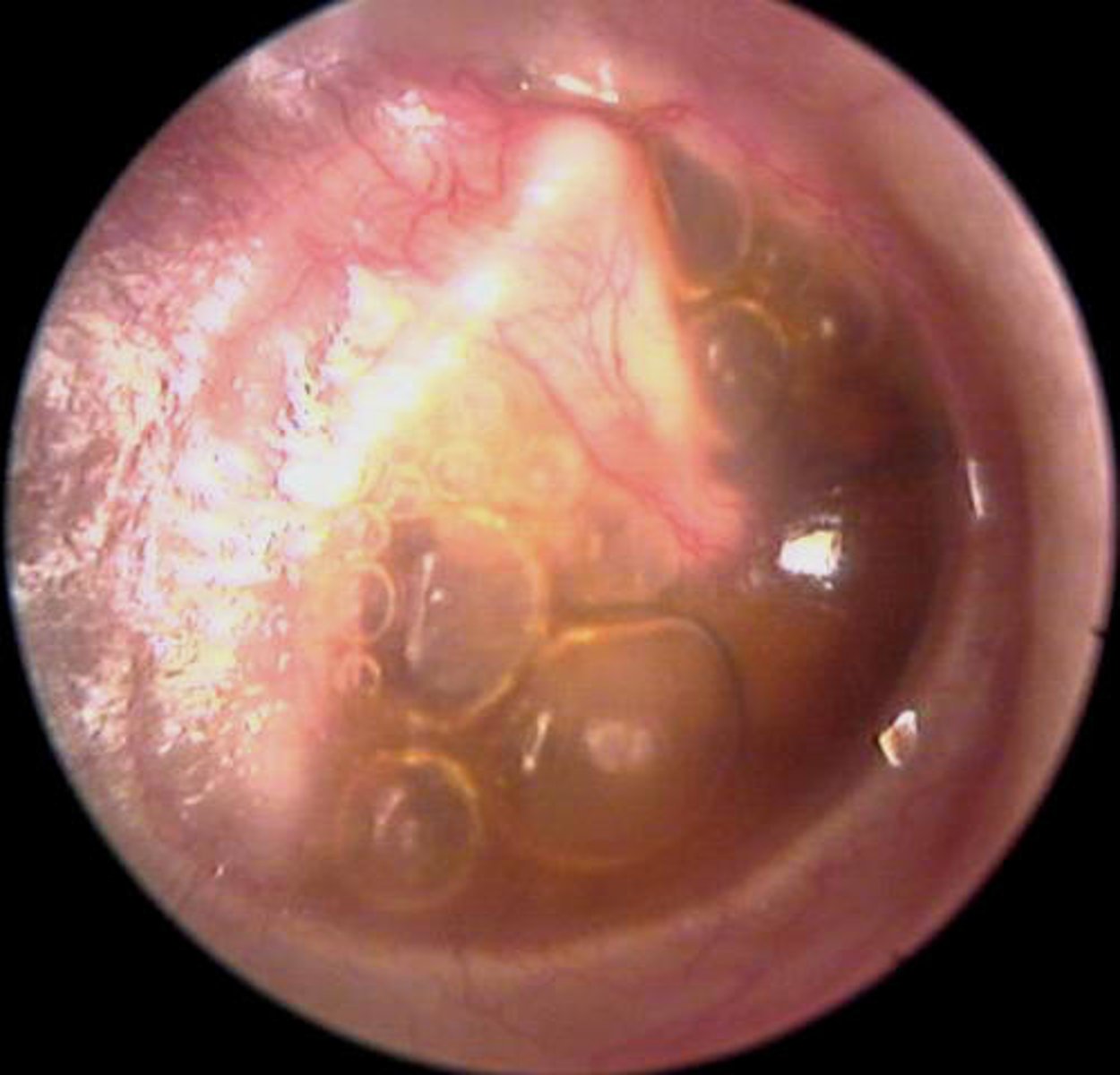 <p>Causes:</p><p>Viral URTI</p><p>O. Barotrauma</p><p>Eustachian tube cannot equalise air pressure in middle ear with outside ear</p><p>~</p><p>Air is absorbed &amp; replaced with serous fluid (amber colour) - NB</p><p>~</p><p>Sxs:</p><p>Fullness/Popping</p><p>Mild conductive HL</p><p>Otalgia</p><p>~</p>