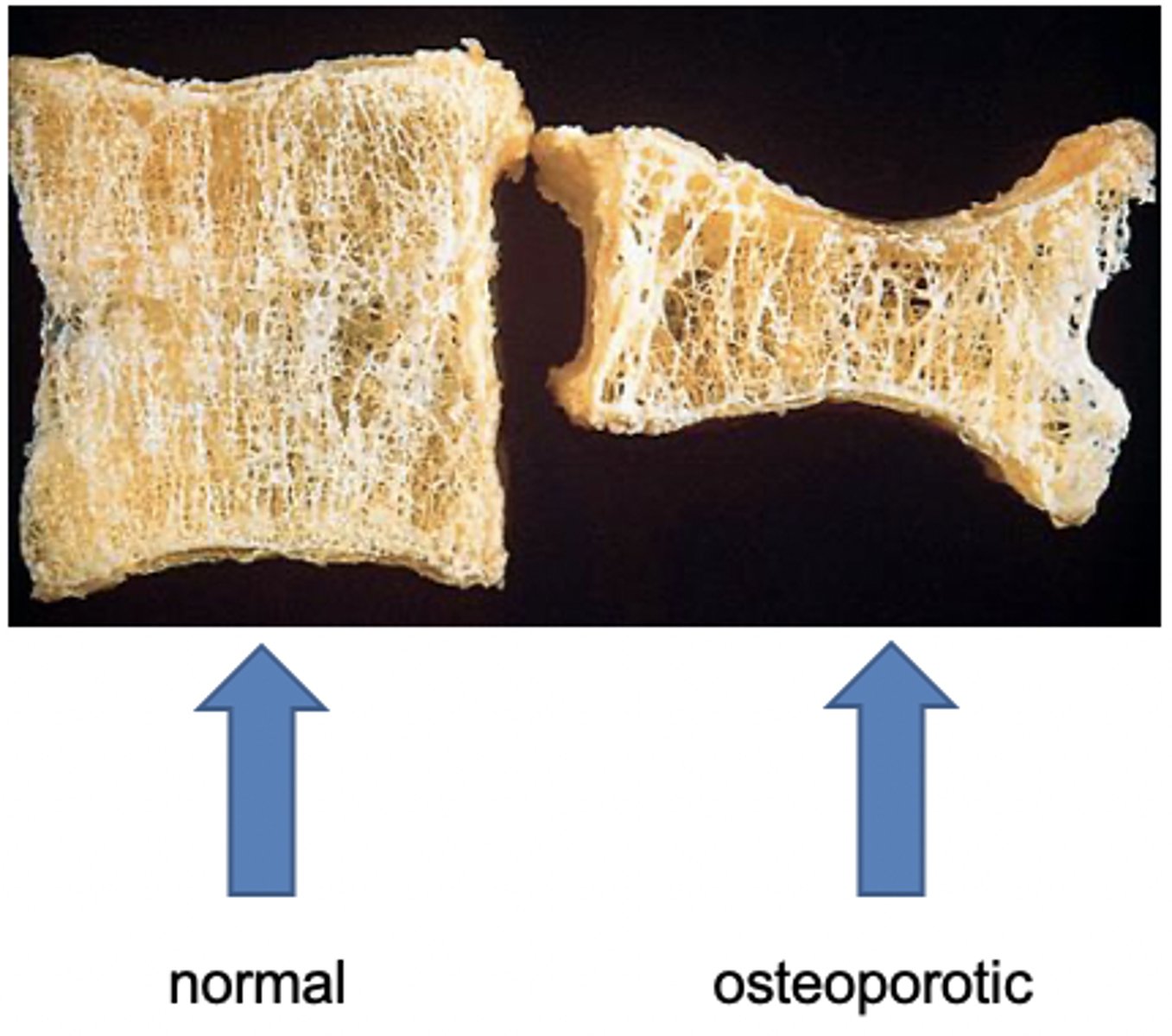 <p>loss of bone <strong>density </strong>leading to decreased bone strength/increased susceptibility to fractures</p>